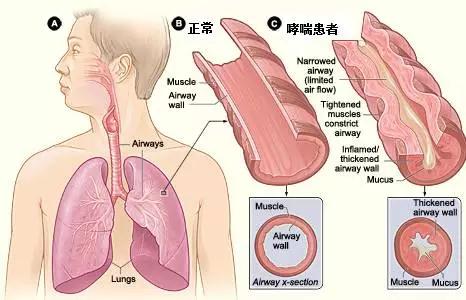 哮喘-呼吸-呼吸肌-肺病-鄧麗君-遺傳-咳嗽-呼吸困難-肺功能檢測(cè)儀