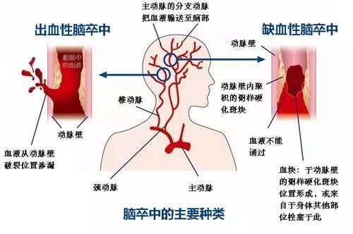 肺炎-呼吸訓(xùn)練器-基層肺功能-腦卒中-心血管病-中風(fēng)-腦梗-慢阻肺-哮喘-呼吸肌-排痰-肺功能檢測(cè)儀-賽客