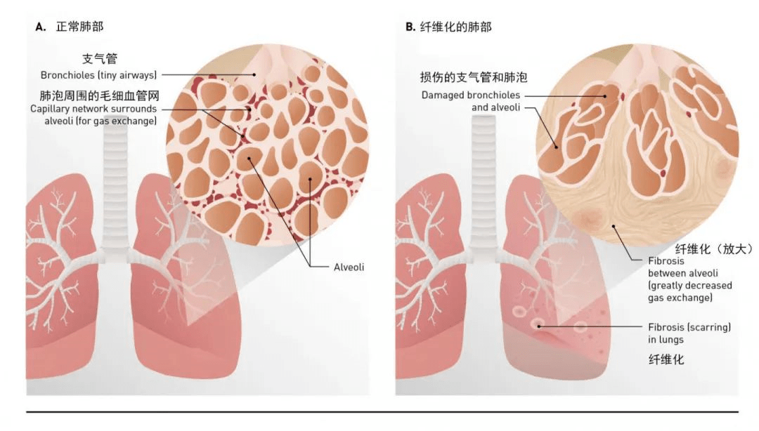 肺纖維化-肺炎-吸煙-特發(fā)性肺纖維化-肺功能-肺功能檢測儀-呼吸訓練器-慢阻肺-哮喘-免疫力-咽炎-咳嗽-干咳-呼吸肌